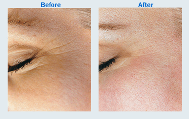 microdermabrasion for crows feet microdermabrasion for crows feet
