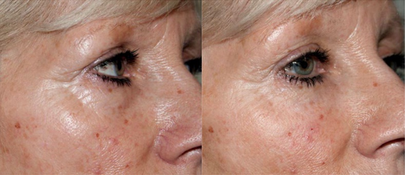 Before and After Redensity II Tear Trough Injections