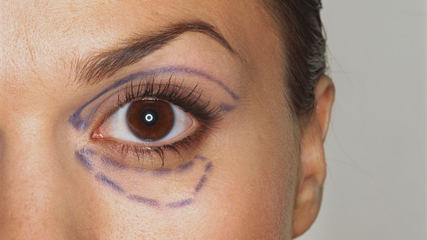 eyelid surgery