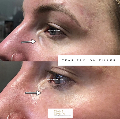 tear troughs Manchester tear troughs Manchester
